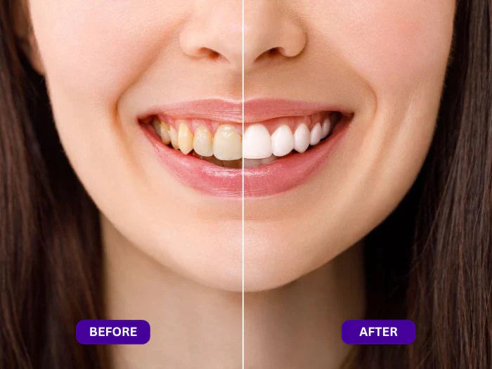 Dentley™ Purple Whitening Strips